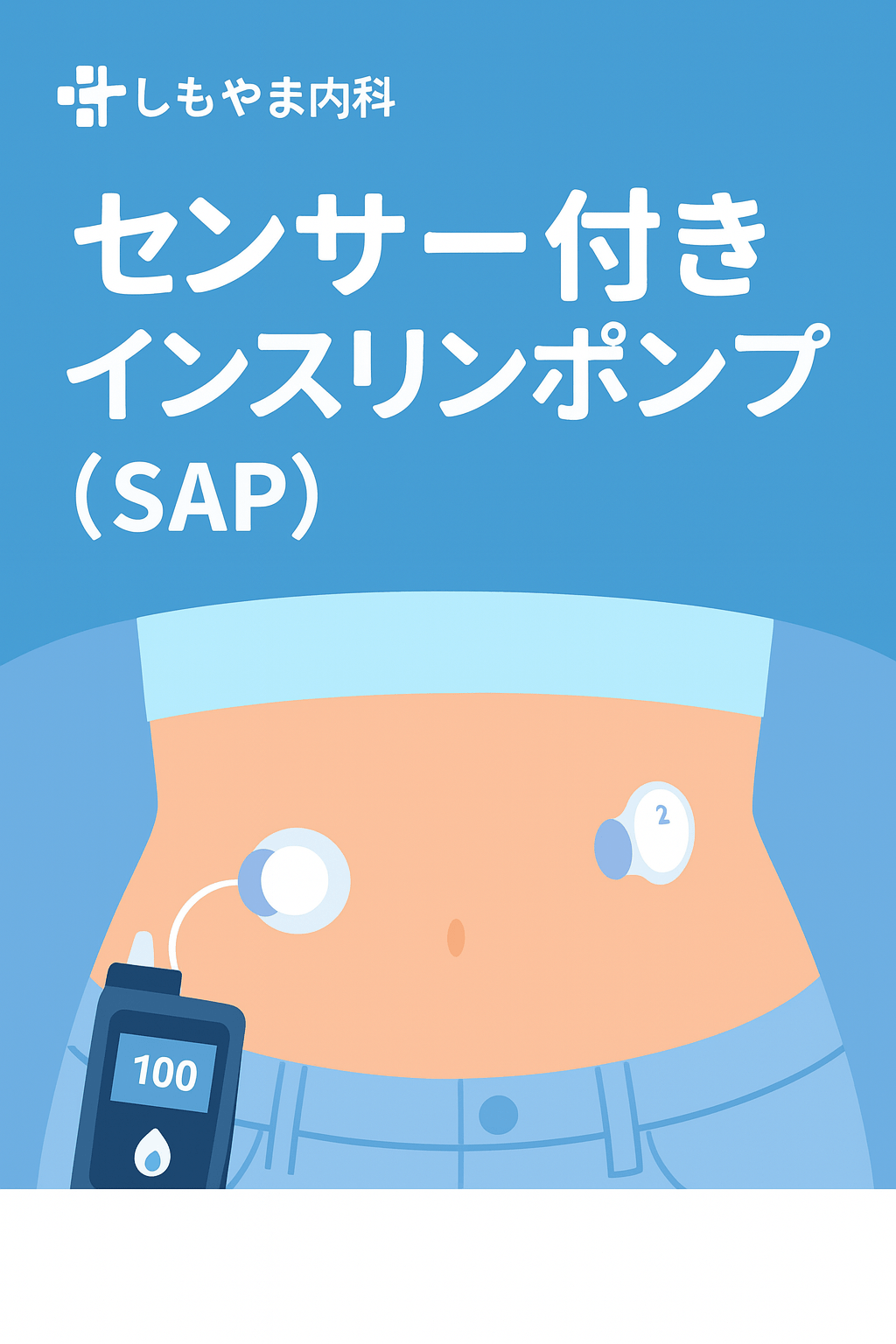 センサー付きインスリンポンプ（SAP）780Gの装着イメージ｜しもやま内科