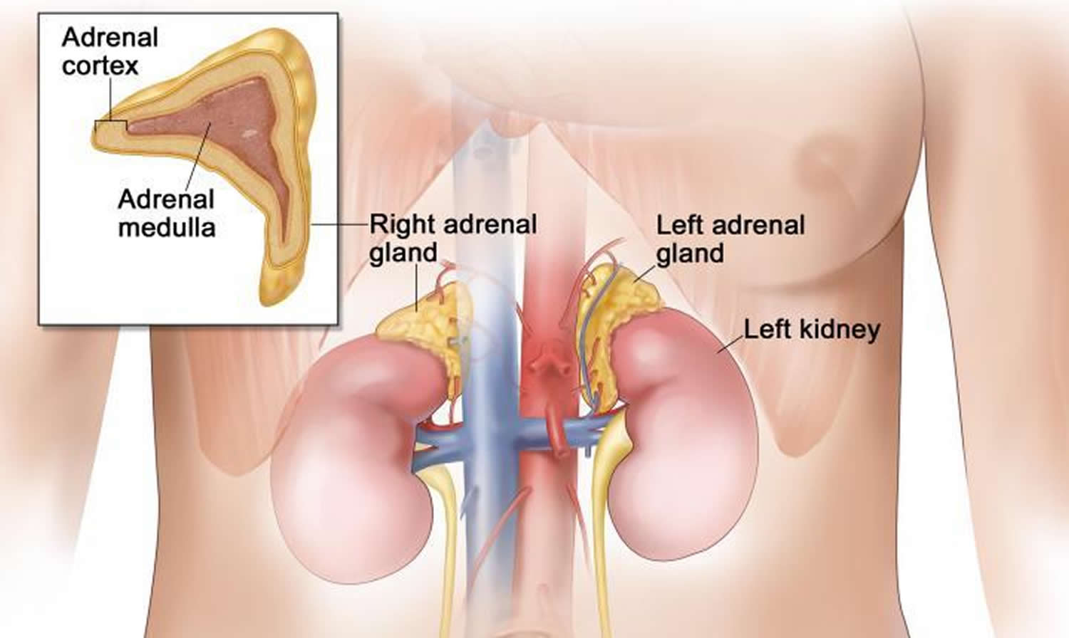 pheochromocytoma