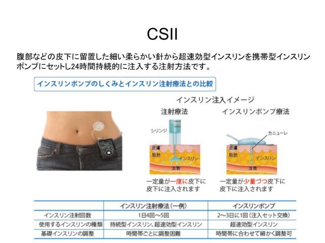 CSII インスリンポンプ療法