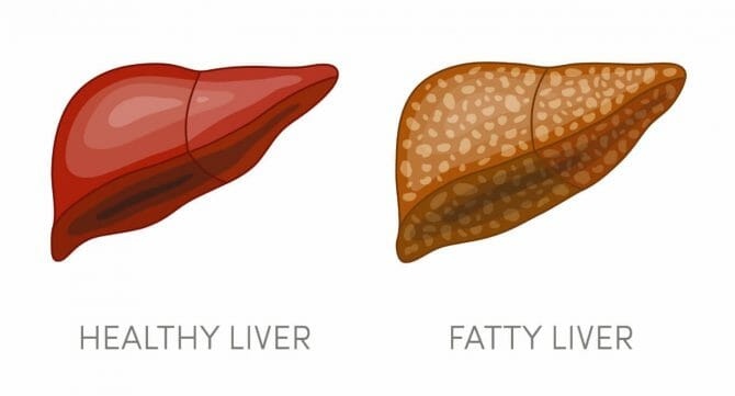 脂肪肝 NASH/NAFLD