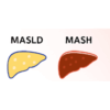 NASH・NAFLDにおける肝疾患の進行ステージ（正常な肝臓 → MASLD → MASH → 肝硬変）