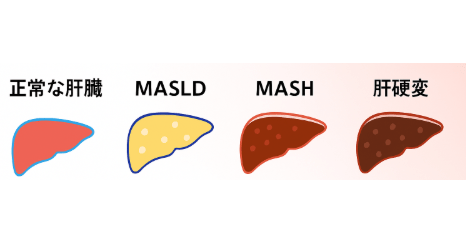 NASH・NAFLDにおける肝疾患の進行ステージ(正常な肝臓 → MASLD → MASH → 肝硬変)