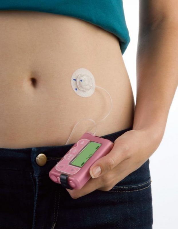 インスリンポンプ療法 CSII しもやま内科