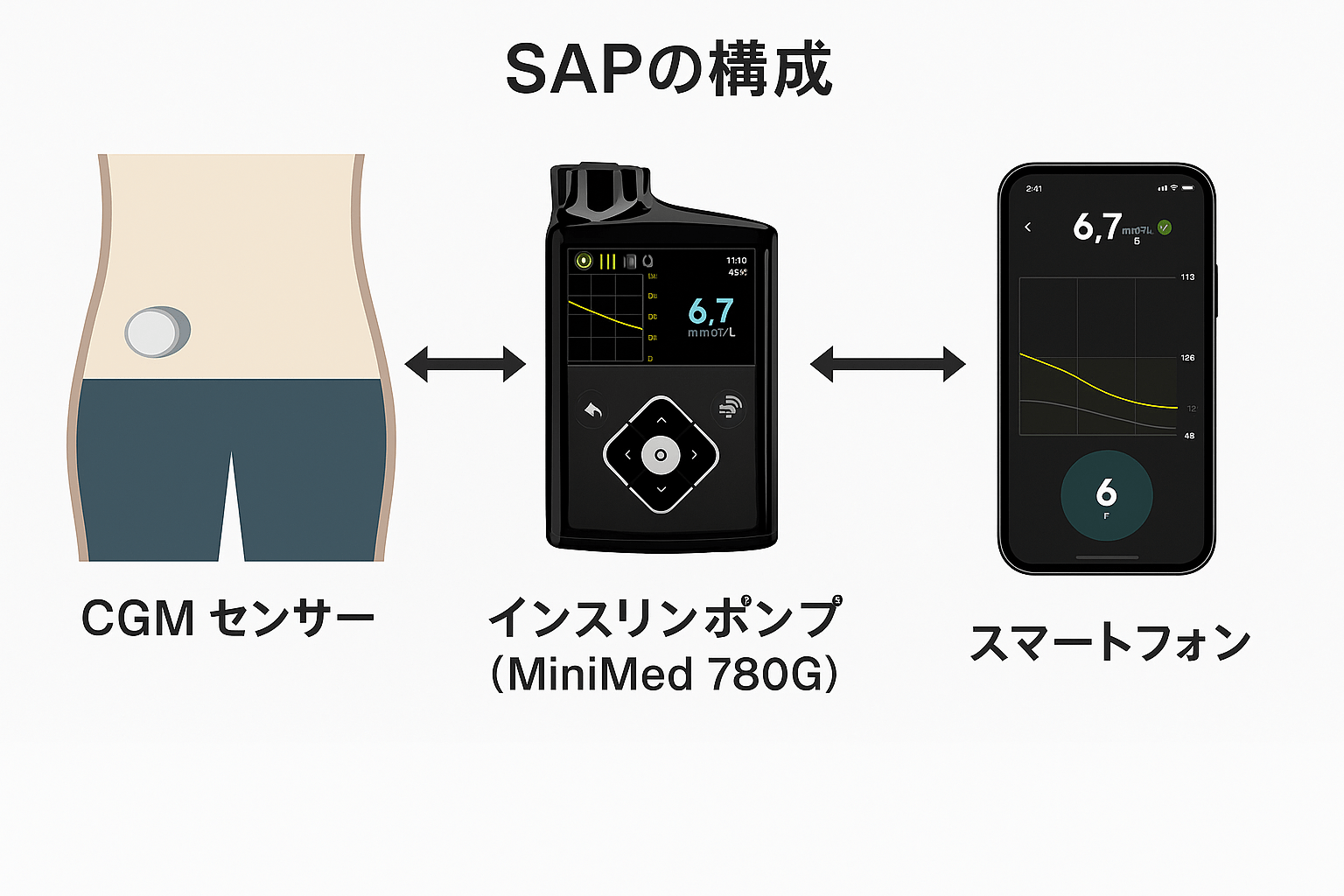 SAPの構成（CGMセンサー・インスリンポンプMiniMed 780G・スマートフォン連携）