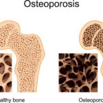 osteoporosis