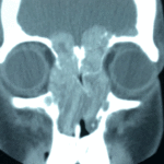 Eosinophilic Sinusitis