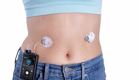 Medtronic 780G
