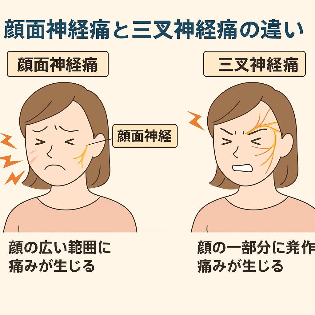 顔面神経痛と三叉神経痛の違いを解説するイラスト。顔面神経痛は顔の広い範囲に持続的な痛み、三叉神経痛は顔の一部に発作的な痛みが出る