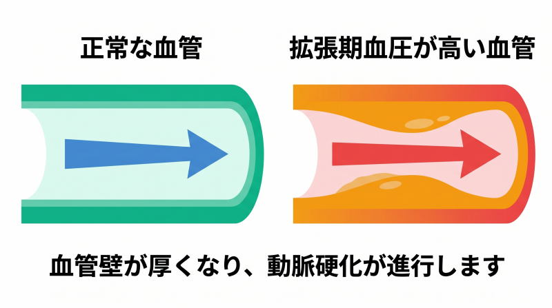 拡張期血圧が高いと血管に負担がかかる様子