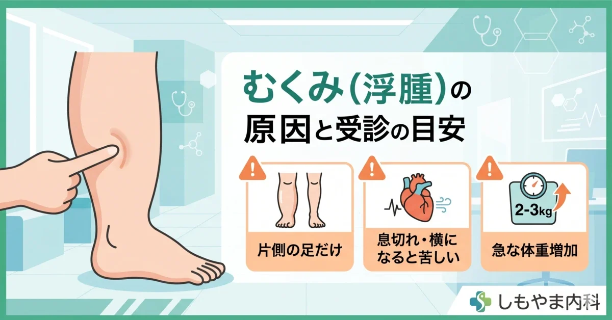 しもやま内科による「むくみ(浮腫)の原因と受診の目安」を解説する、清潔で現代的な医療イラストのアイキャッチ画像(1200x628)。左側には、むくんだ足首に指が食い込んでいる様子が描かれ、右側には日本の見出し「むくみ(浮腫)の原因と受診の目安」が大きく表示されている。その下には、医師への早期受診が必要な重大な兆候を説明する3つのアイコンパネルが並ぶ。1. 片側の足だけ、2. 心臓の問題と息切れ、3. 急な体重増加。全体は白と緑を基調とした信頼感のある配色で、下部には小さなクリニックのロゴ「しもやま内科」が配置されている。