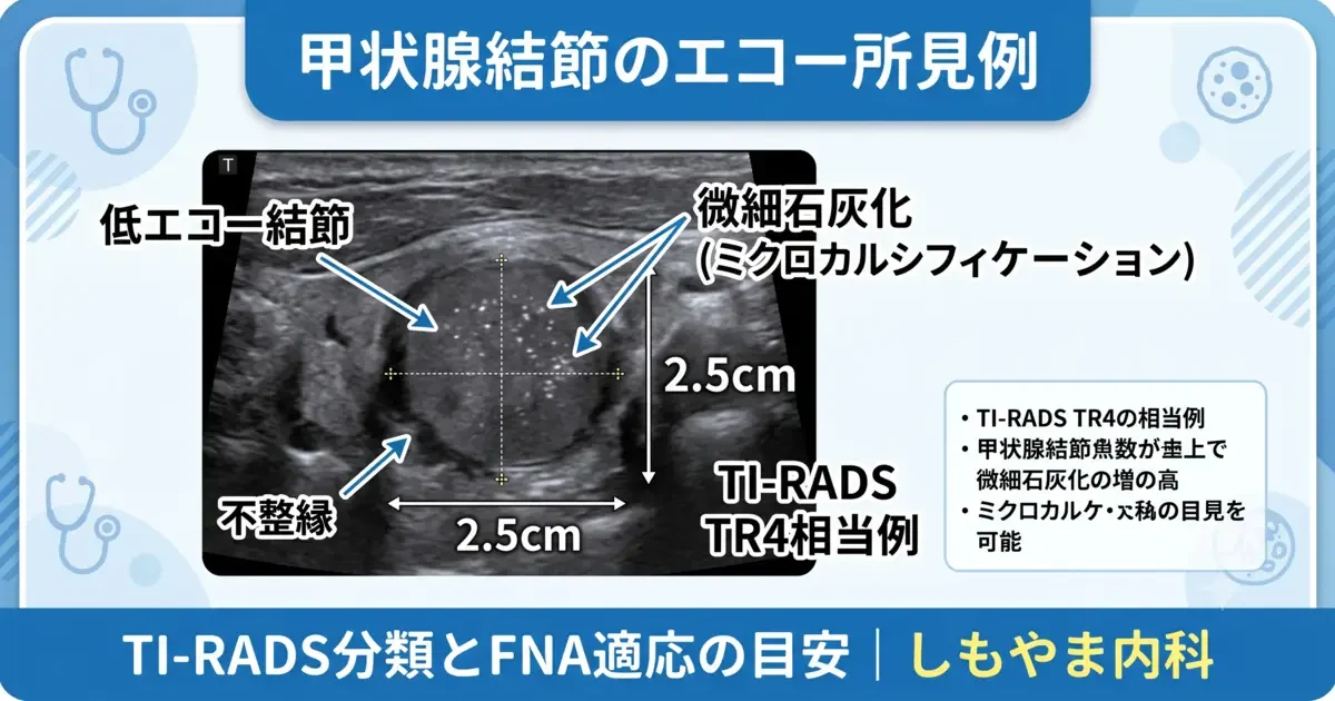甲状腺エコー画像例：低エコー結節と微細石灰化（ミクロカルシフィケーション）。TI-RADS評価のポイントを解説